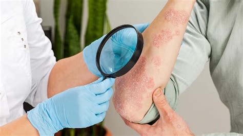 psoriasis diagnosis results